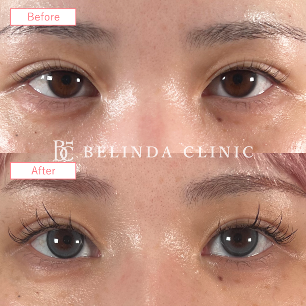 二重整形切開法症例No187