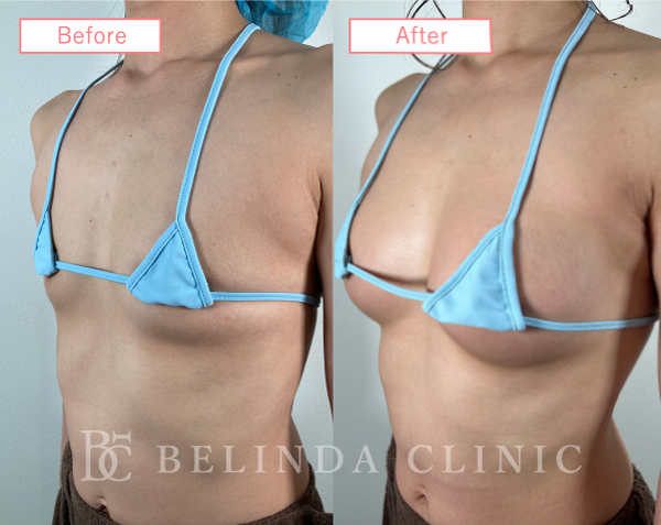 脂肪豊胸症例No233