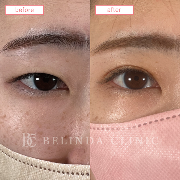 二重整形埋没法症例No273