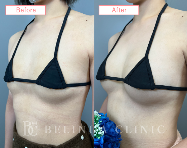 脂肪豊胸症例No2994