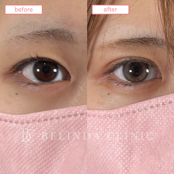 二重整形埋没法症例No356