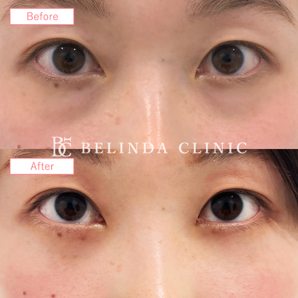 クマ取り症例No4349