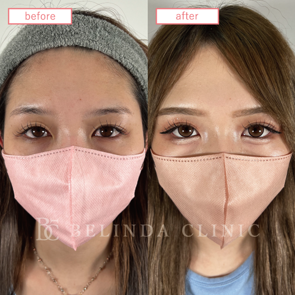 二重整形埋没法症例No441