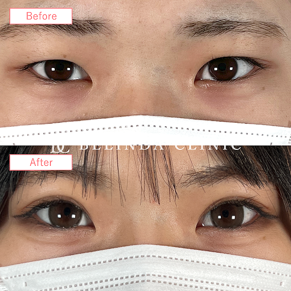 二重整形埋没法症例No493