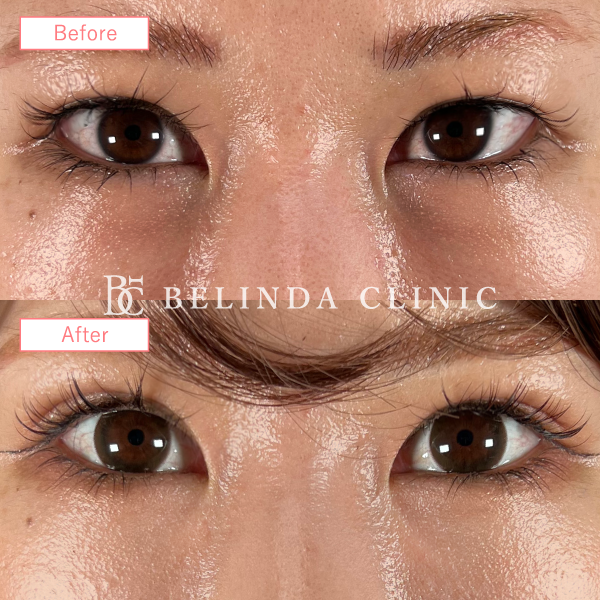 二重整形埋没法症例No501