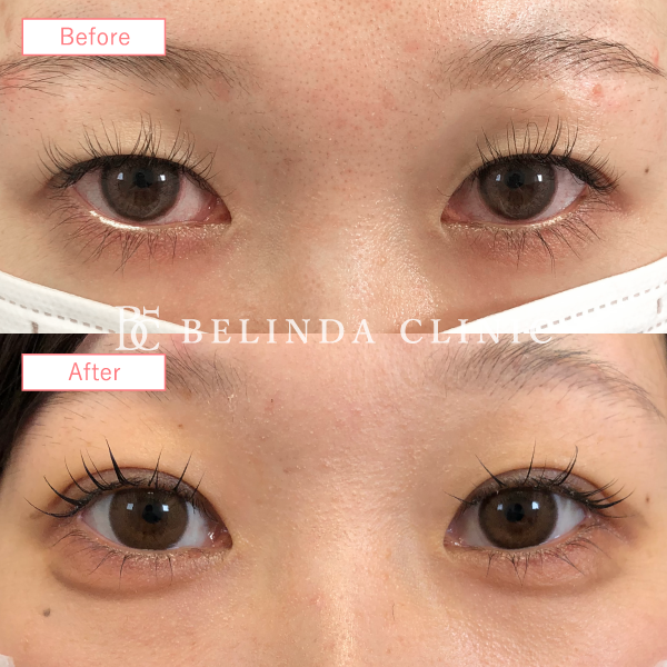 二重整形埋没法症例No5544