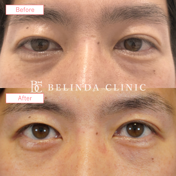 切らないクマ取り・裏ハムラ法症例No5554