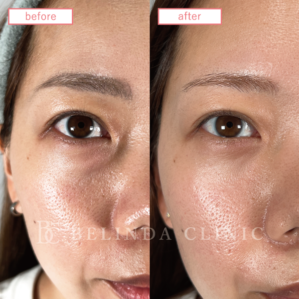 クマ取り症例No582