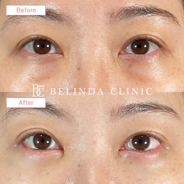 切らないクマ取り・裏ハムラ法No640