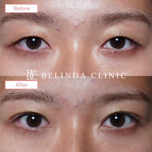 二重整形埋没法症例No6460