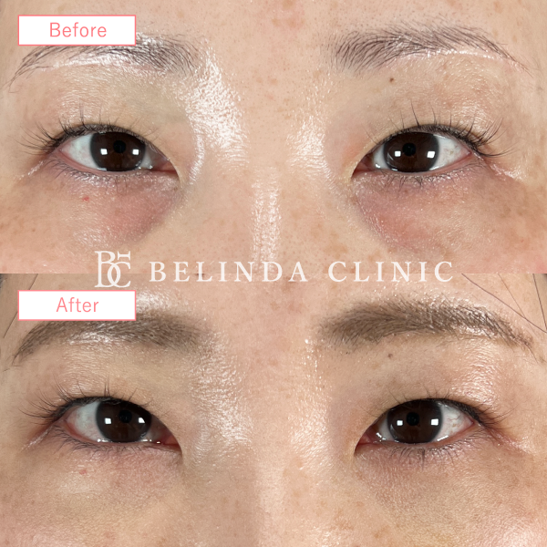 切らないクマ取り・裏ハムラ法No717