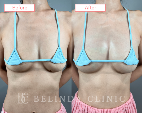 脂肪豊胸症例No735