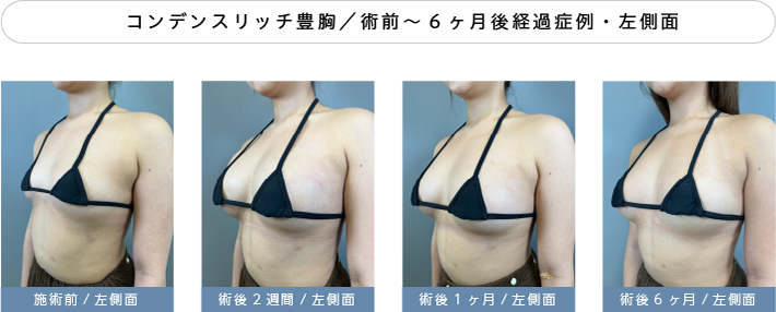 脂肪注入豊胸半年経過症例01