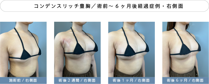 脂肪注入豊胸半年経過症例02