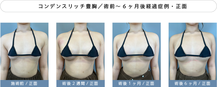 脂肪注入豊胸半年経過症例03