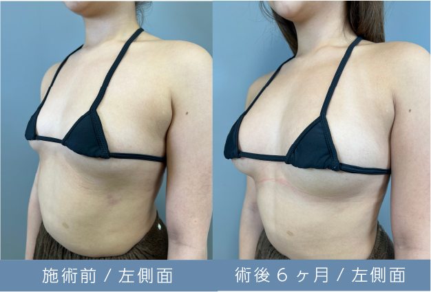脂肪豊胸定着後画像01