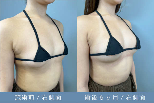 脂肪豊胸定着後画像02