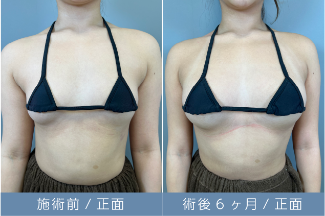 脂肪豊胸定着後画像03