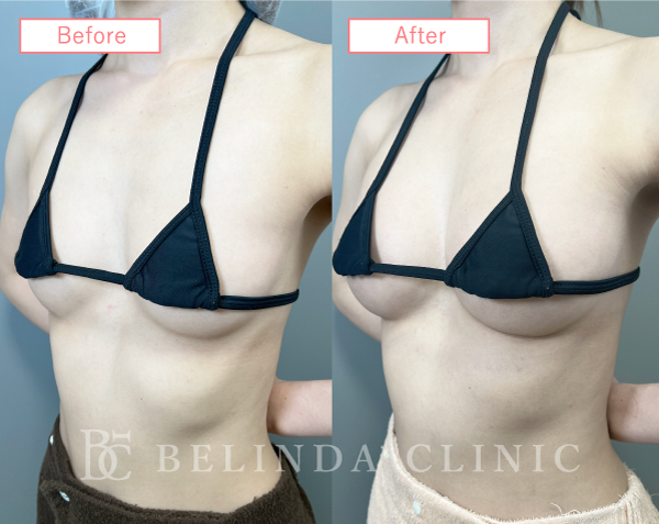 脂肪豊胸症例No2087_01