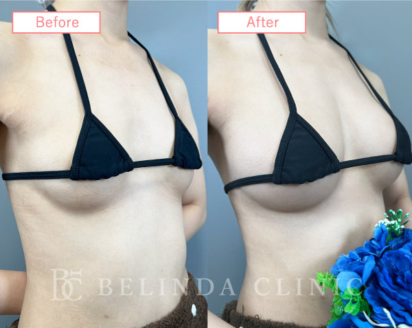 脂肪注入豊胸症例09