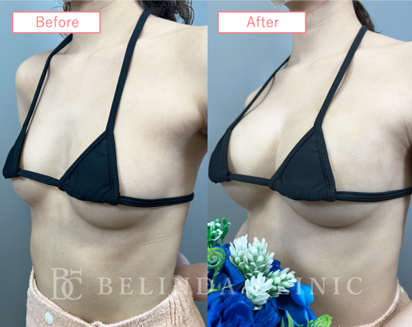 脂肪豊胸症例No2816