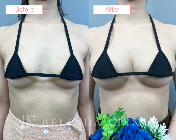 脂肪豊胸症例No2816_01