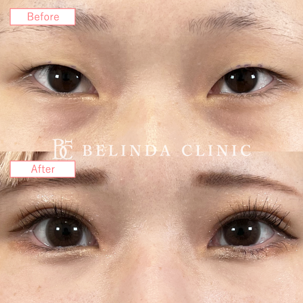 二重整形埋没法症例No3881