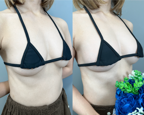 脂肪豊胸症例No3883