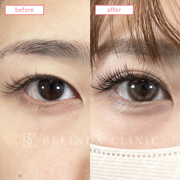 二重整形埋没法症例No3920