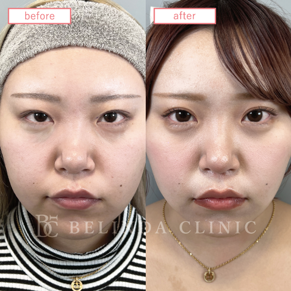 二重整形埋没法症例No4417