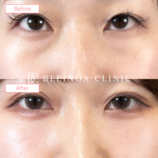 切らないクマ取り・裏ハムラ法症例No5447