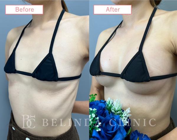 ハイブリット豊胸ビフォーアフターcase06