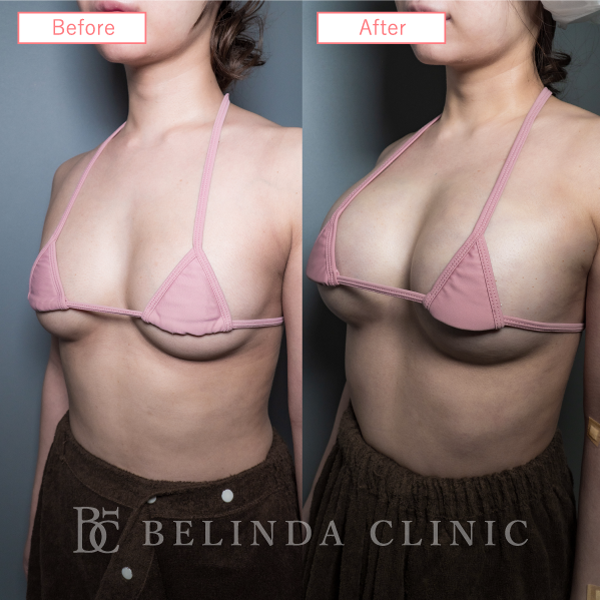 脂肪豊胸症例No6423