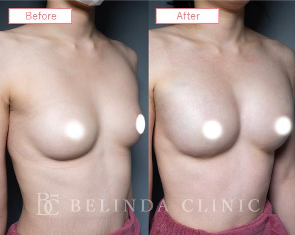 脂肪豊胸症例No6449