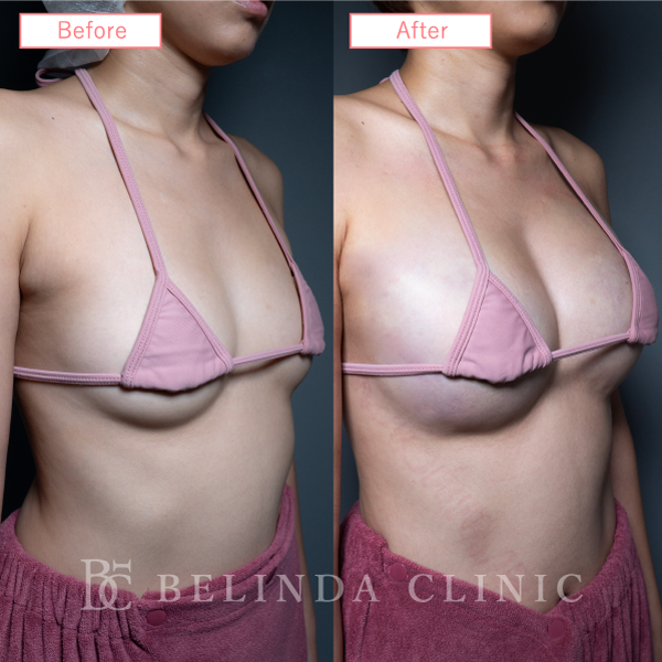 脂肪注入豊胸症例17