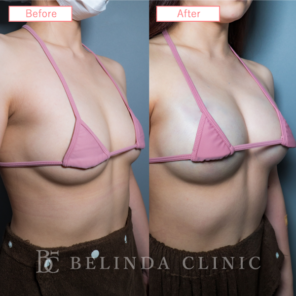 脂肪豊胸症例No6520