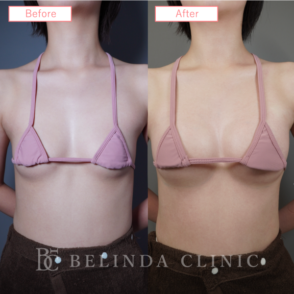 ヒアルロン酸豊胸症例No6228