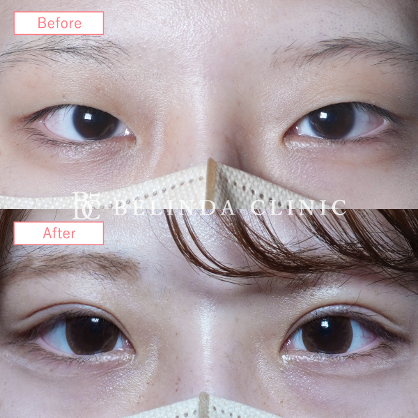 二重整形埋没法症例No6231