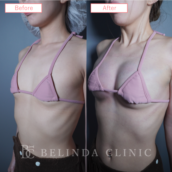 脂肪豊胸症例No6256