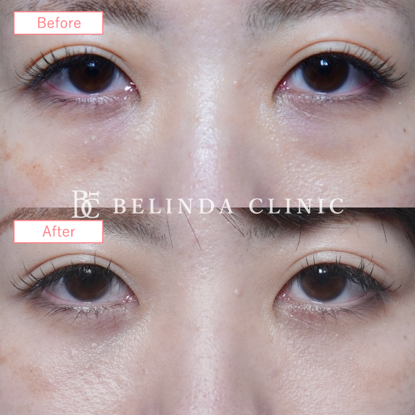 切らないクマ取り・裏ハムラ法症例No6416