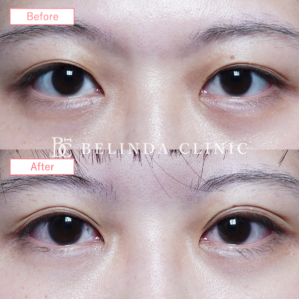 二重整形埋没法症例No6434