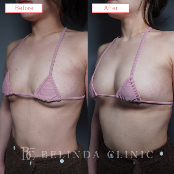 脂肪豊胸症例No6442