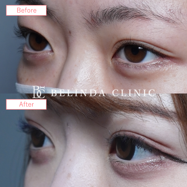 二重整形埋没法症例No6465