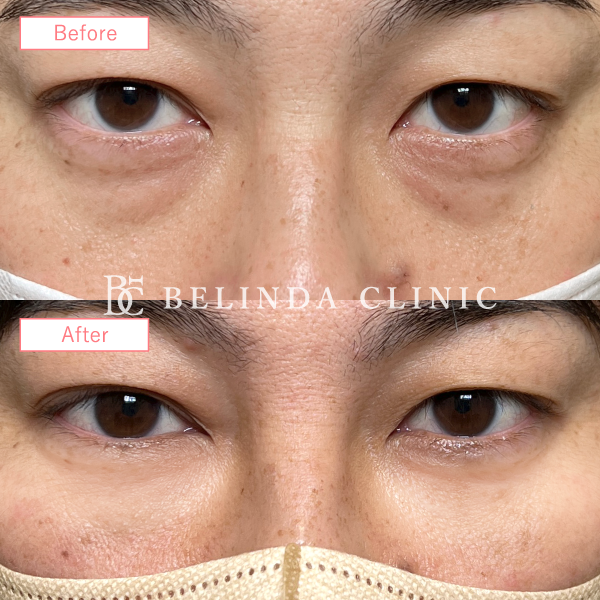 切らないクマ取り・裏ハムラ法症例No6491