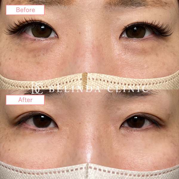 切らないクマ取り・裏ハムラ法症例No6492