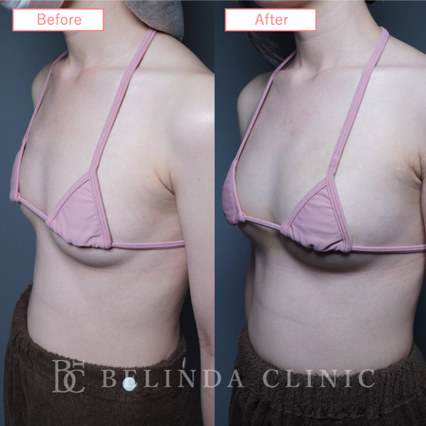 脂肪豊胸症例No6523