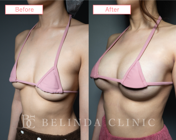 脂肪注入豊胸症例16