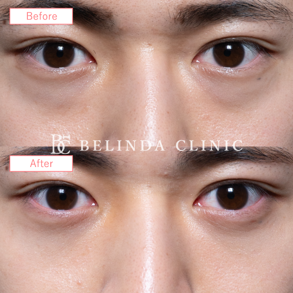 切らないクマ取り・裏ハムラ法症例No6595