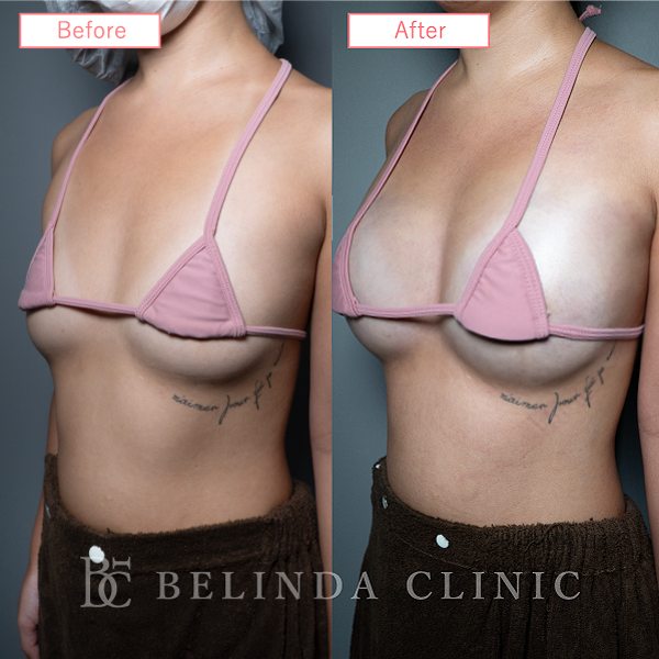 脂肪豊胸症例No6957