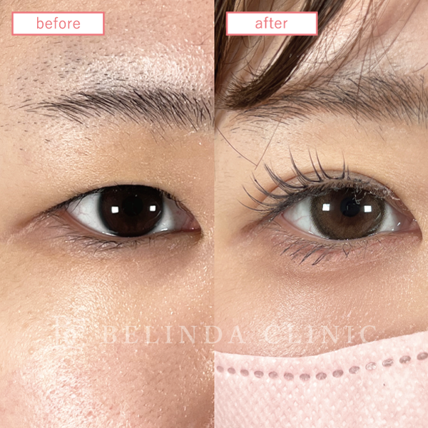 二重整形埋没法症例No547